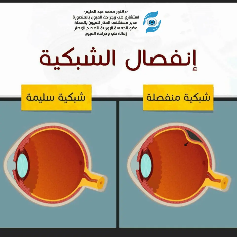 انفصال الشبكية